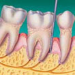 periodontite avançada
