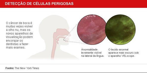 cancer bucal - esquema