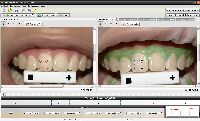 software de clareamento dental