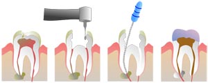 endodontia