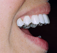 ortodontia lingual 