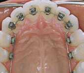 aparelho ortodontico  invisivel
