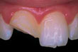 fratura dental