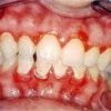 Doença Periodontal