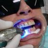 clareamento dental a laser