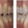 clareamento dental grátis