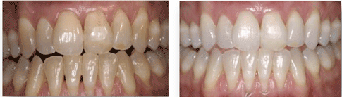 clareamento dental grátis