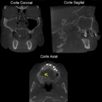 Tomografia Osteonecrose - Créditos Boletim cientifico Papaiz Associados