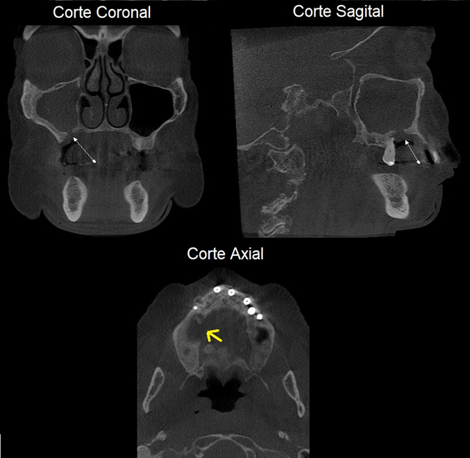 Tomografia Osteonecrose - Créditos Boletim cientifico Papaiz Associados